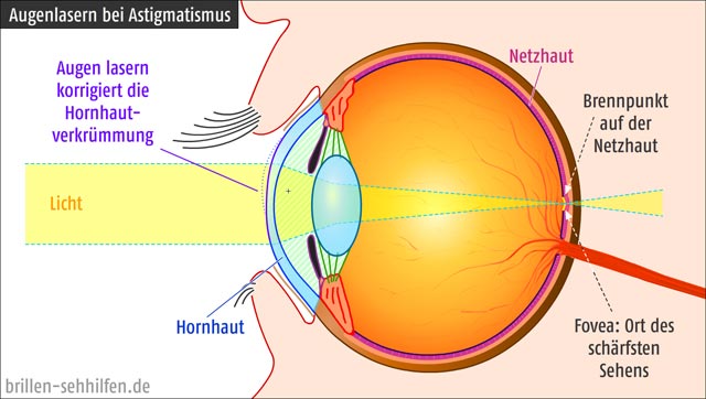 Augenlasern bei Astigmatismus (Hornhautverkrümmung)