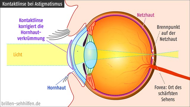 Kontaktlinse gegen Astigmatismus (Hornhautverkrümmung)