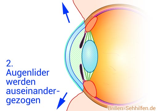 Laser-Augenkorrektur