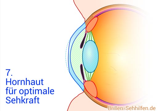Laser-Augenoperation: Hornhaut bearbeitet und Brechkraft optimiert