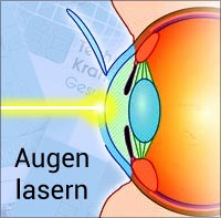 Augen lasern Krankenkassen