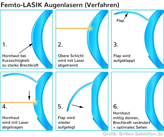 Femto-LASIK: etabliertes Augenlaser-Verfahren