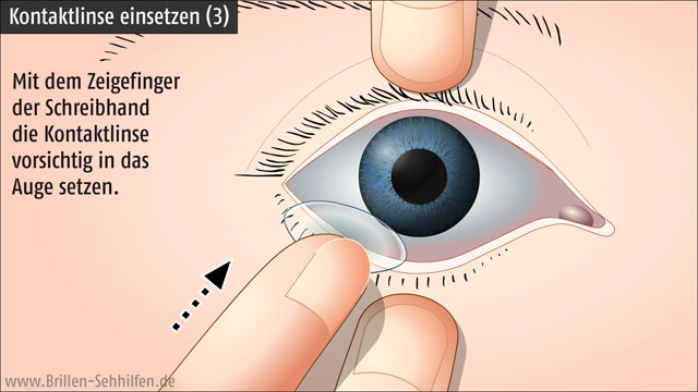 Kontaktlinsen einsetzen