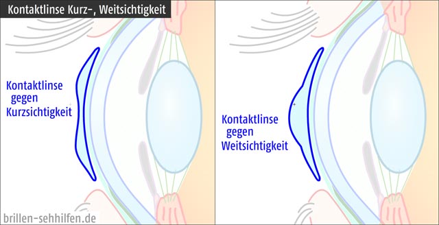 Kontaktlinsen Unterschied Kurzsichtigkeit / Weitsichtigkeit